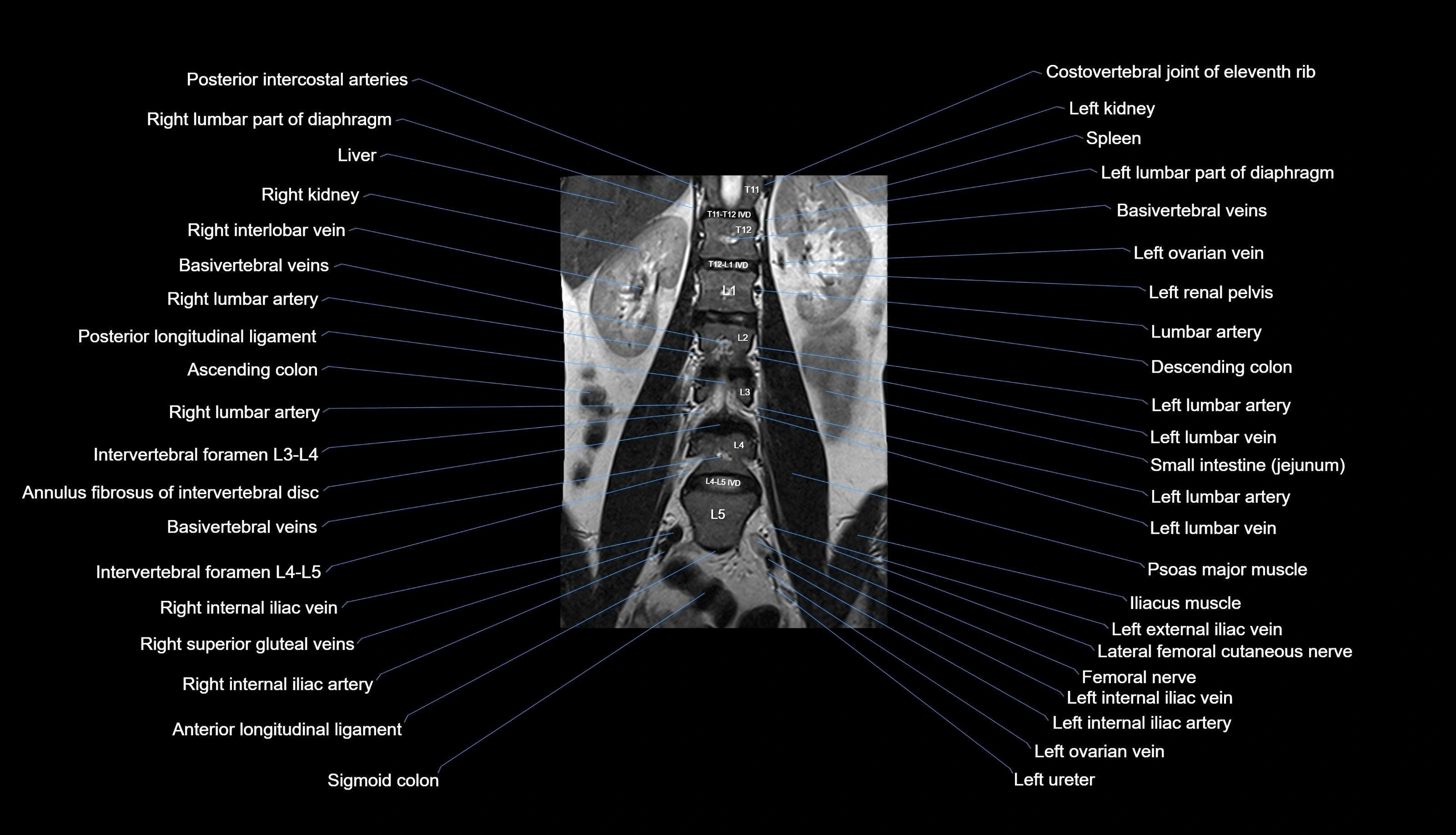 MRI lumbar spine labelled coronal cross sectional anatomy 3T radiology-img-00001-00015.webp